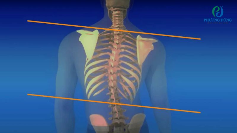 Hệ luỵ do vẹo xương sống gây ra