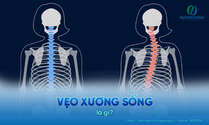 Hình ảnh xương sống bình thường và xương sống bị vẹo
