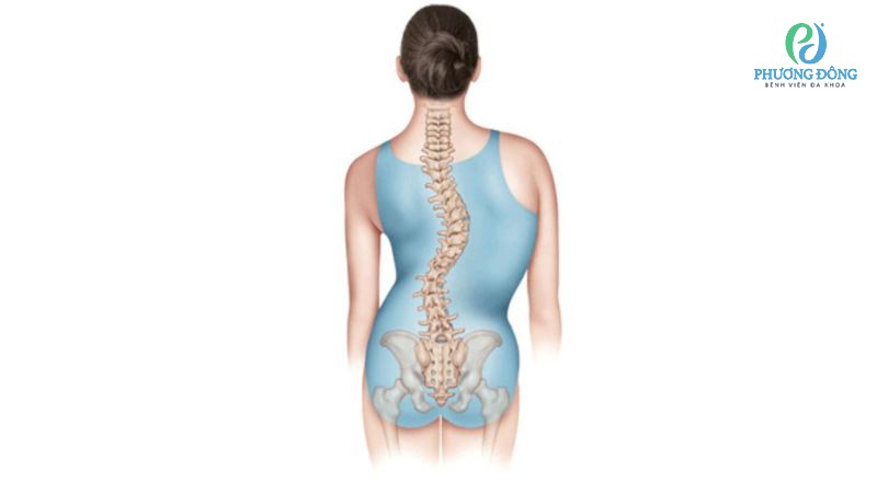 Cong cột sống hình chữ S