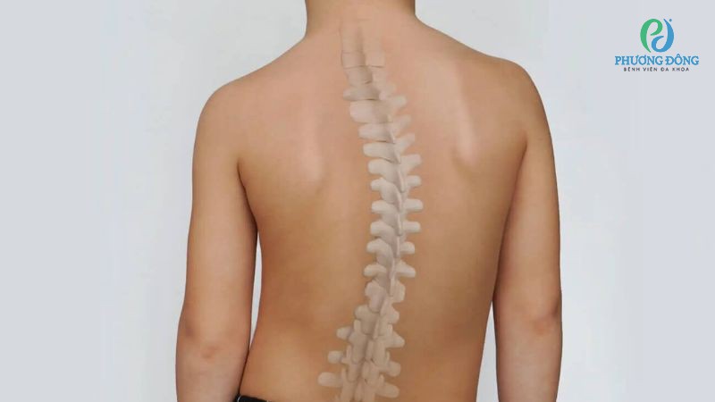 Vẹo cột sống bẩm sinh là một bất thường hiếm gặp ở trẻ sơ sinh