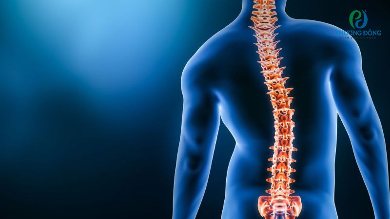 Vẹo cột sống thần kinh cơ khởi phát do các bệnh lý bại não, teo cơ hoặc loạn dưỡng cơ