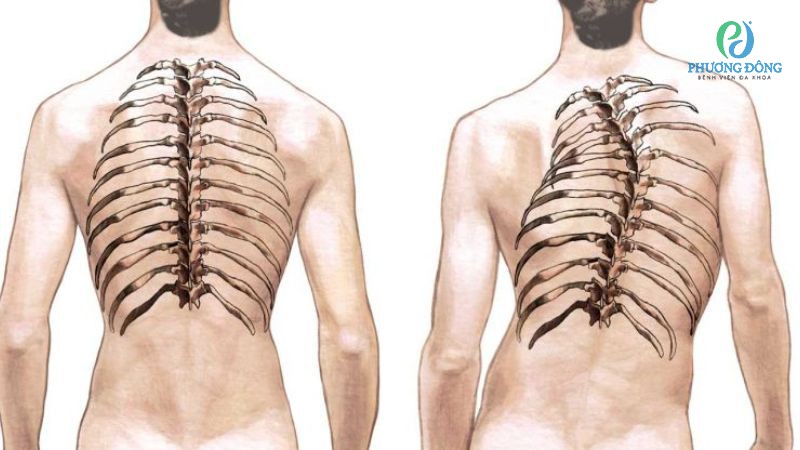 Dấu hiệu nhận biết cột sống bị cong vẹo