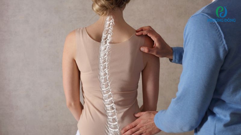 Cải thiện vẹo xương sống bằng các bài tập phù hợp