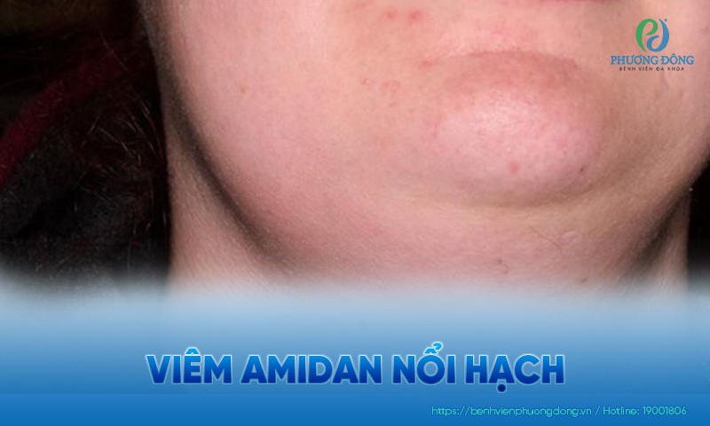 Viêm amidan nổi hạch: Nguyên nhân, biến chứng và điều trị