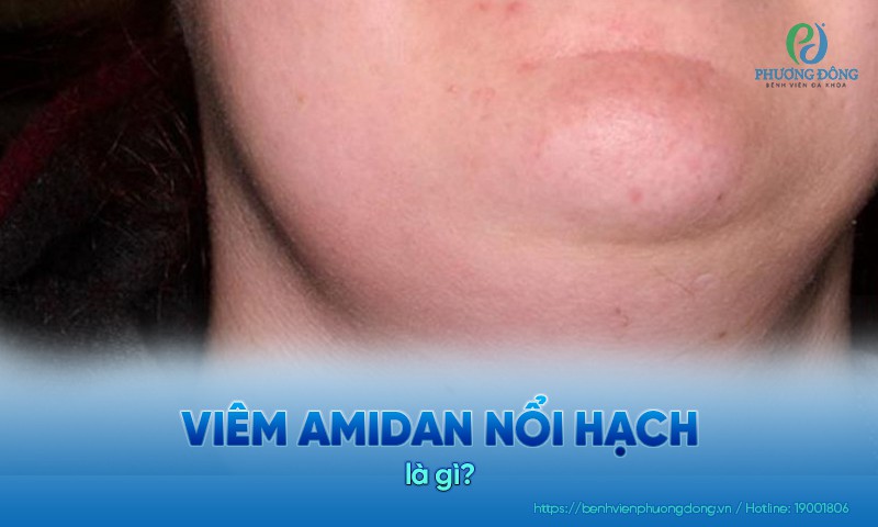 Viêm amidan nổi hạch là hiện tượng hạch cổ sưng do virus, vi khuẩn