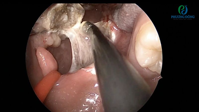 Hướng điều trị viêm amidan mạn tính