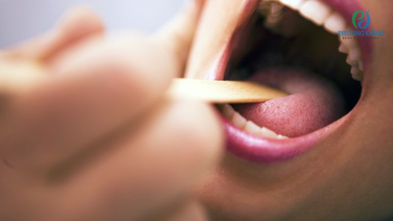 Một số lưu ý khi điều trị, chăm sóc bệnh nhân nổi hạch do viêm amidan