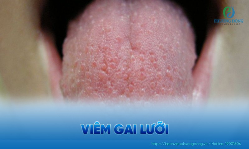 Viêm gai lưỡi: Nguyên nhân, triệu chứng và cách điều trị