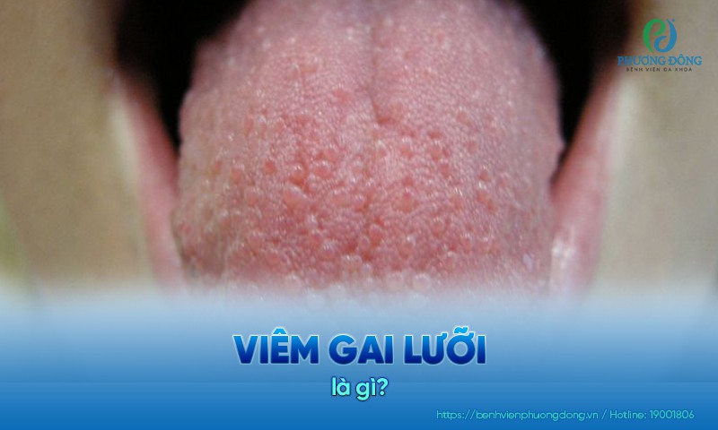 Viêm gai lưỡi là tình trạng bề mặt lưỡi bị viêm, sưng và đau rát