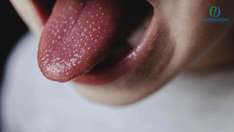Giai đoạn 1 bề mặt lưỡi xuất hiện các vùng ửng đỏ khu trú nhưng chưa lan rộng
