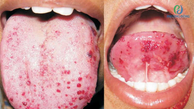Bề mặt gai lưỡi viêm độ 3 thường có màu đỏ tươi