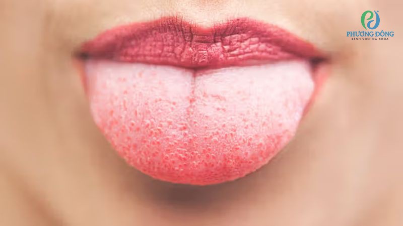 Biểu hiện nhận biết gai lưỡi bị viêm