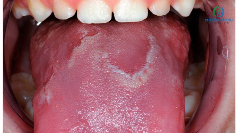 Những biến chứng không mong muốn của viêm gai lưỡi