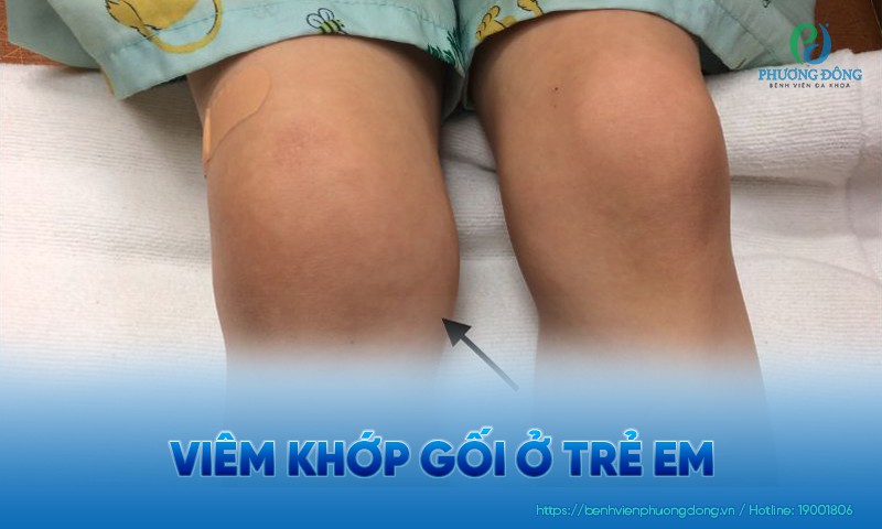 Viêm khớp gối ở trẻ em: Nguyên nhân, triệu chứng và hướng điều trị