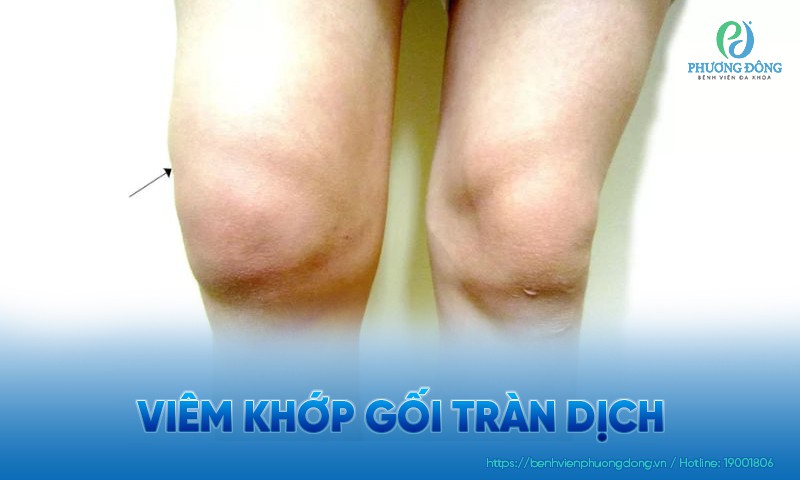 Viêm khớp gối tràn dịch: Nguyên nhân, triệu chứng và hướng điều trị