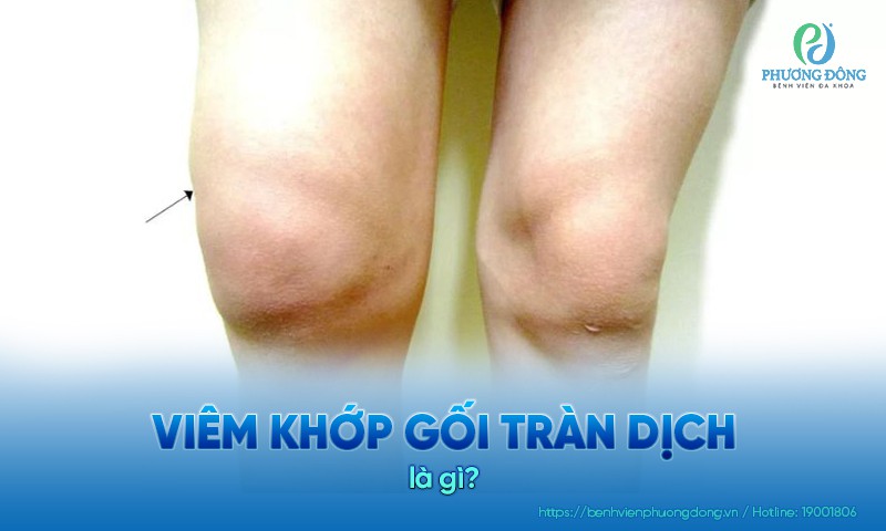 Viêm khớp gối tràn dịch là hiện tượng khớp gối bị viêm làm tăng sản xuất dịch