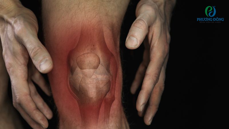 Viêm khớp dạng thấp là nguyên nhân làm tăng sản xuất dịch đầu gối