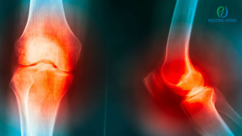 Cơ chế gây tràn dịch đầu gối của viêm khớp nhiễm khuẩn