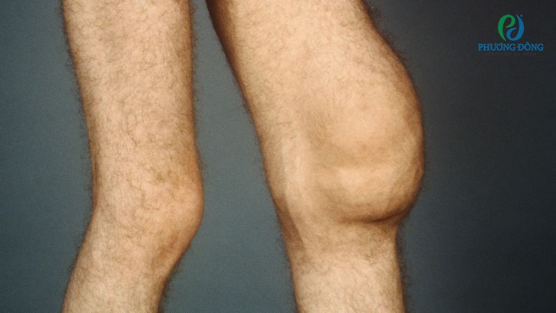 Triệu chứng lâm sàng khi viêm tràn dịch khớp gối