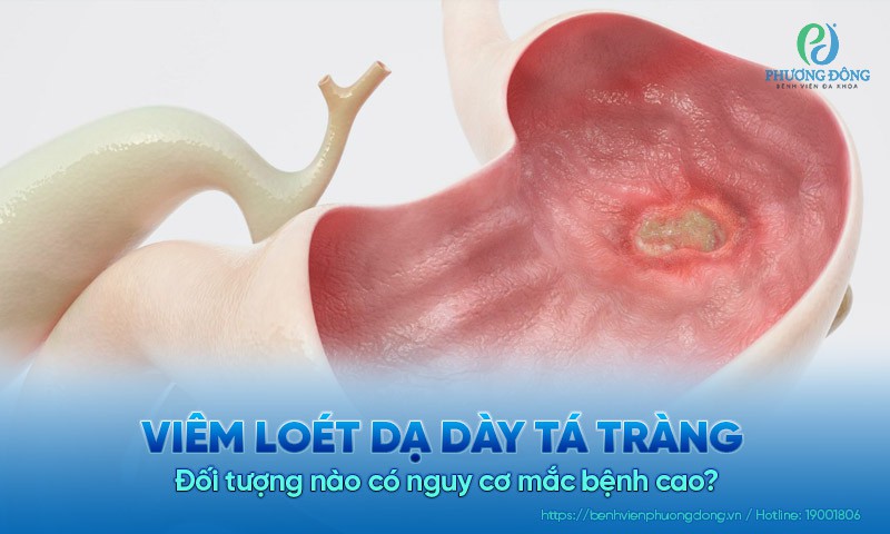 Viêm loét dạ dày tá tràng: Đối tượng nào có nguy cơ mắc bệnh cao?