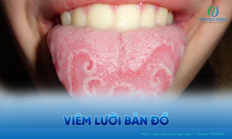 Viêm lưỡi bản đồ: Triệu chứng, nguyên nhân và cách chữa trị