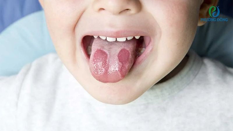 Một số dấu hiệu nhận biết ban đầu