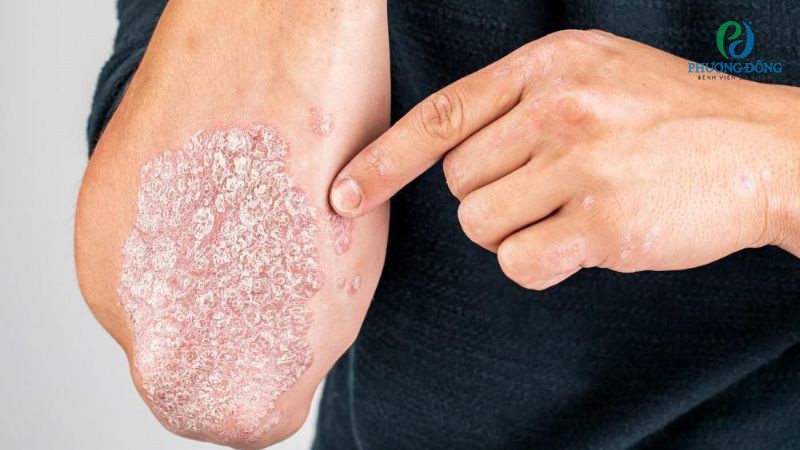 Nguyên nhân hình thành bệnh viêm lưỡi bản đồ