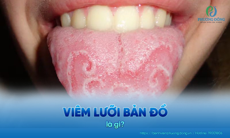 Viêm lưỡi bản đồ phần lớn xuất hiện khi trẻ còn nhỏ hoặc trong thai kỳ