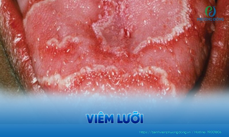 Viêm lưỡi: Nguyên nhân, triệu chứng và phương pháp điều trị