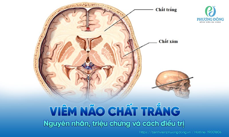 Viêm não chất trắng: Nguyên nhân, triệu chứng và cách điều trị 