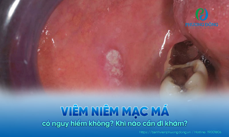 Viêm niêm mạc má có nguy hiểm không? Khi nào cần đi khám?