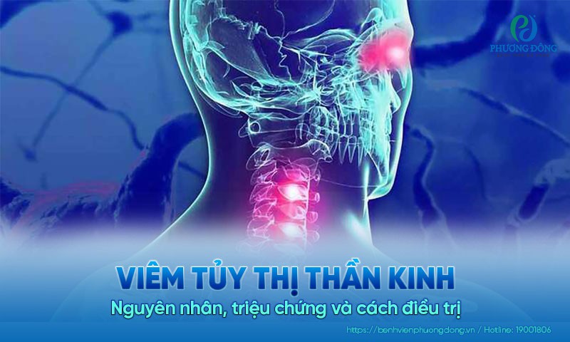 Viêm tủy thị thần kinh: Nguyên nhân, triệu chứng và cách điều trị