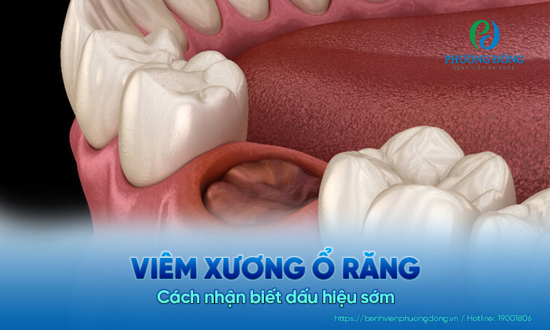 Viêm xương ổ răng biểu hiện thế nào? Cách nhận biết sớm