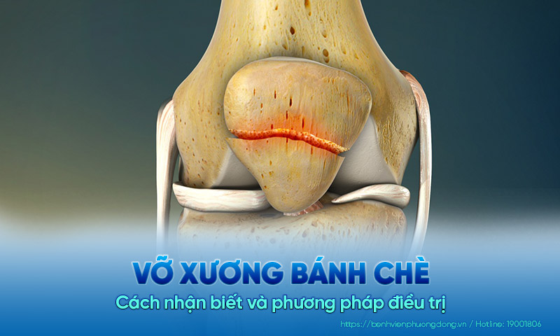Vỡ xương bánh chè: Cách nhận biết và phương pháp điều trị 