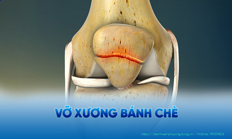 Minh hoạ hình ảnh vỡ xương bánh chè