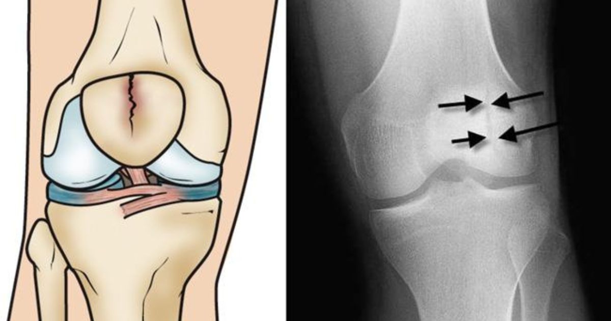 Xương bánh chè bị nứt gãy không di chuyển