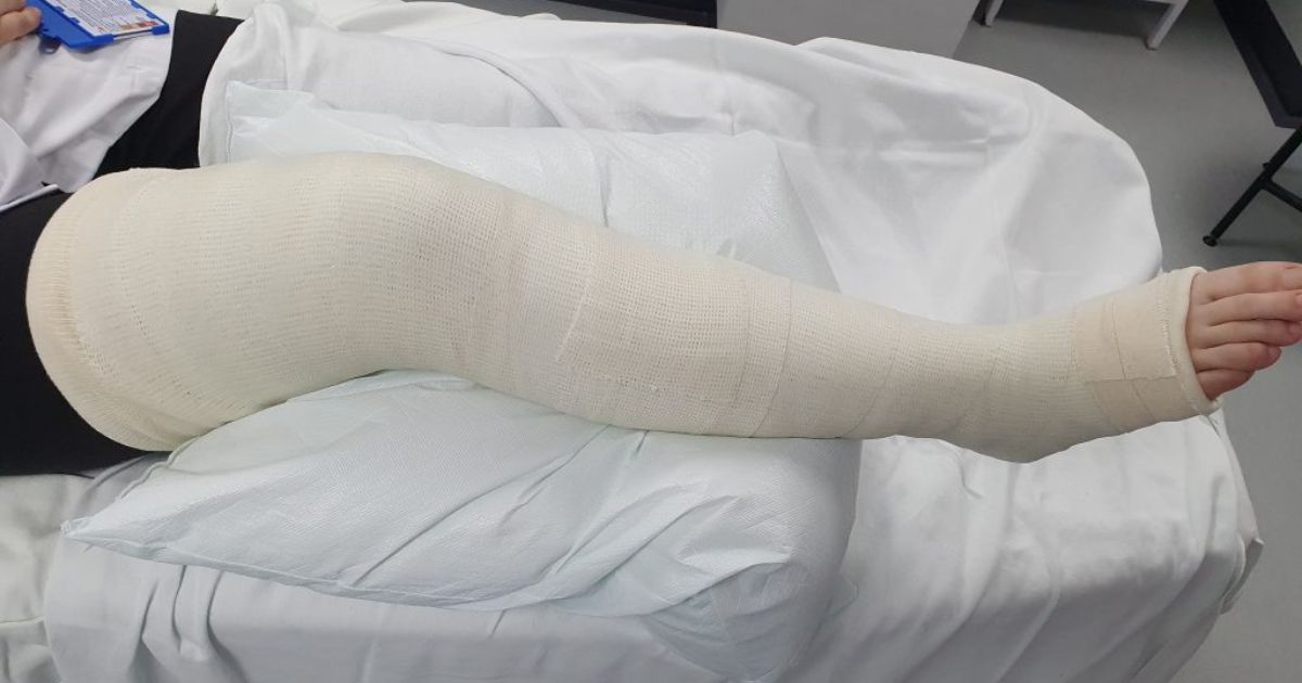 Bạn có thể phải bó bột để điều trị vỡ xương