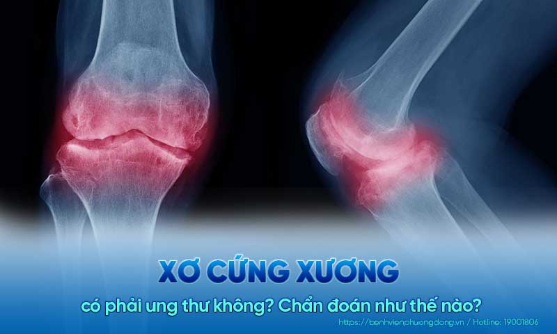 Xơ cứng xương có phải ung thư không? Chẩn đoán như thế nào?