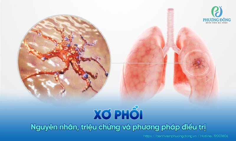 Xơ phổi: Nguyên nhân, triệu chứng và phương pháp điều trị