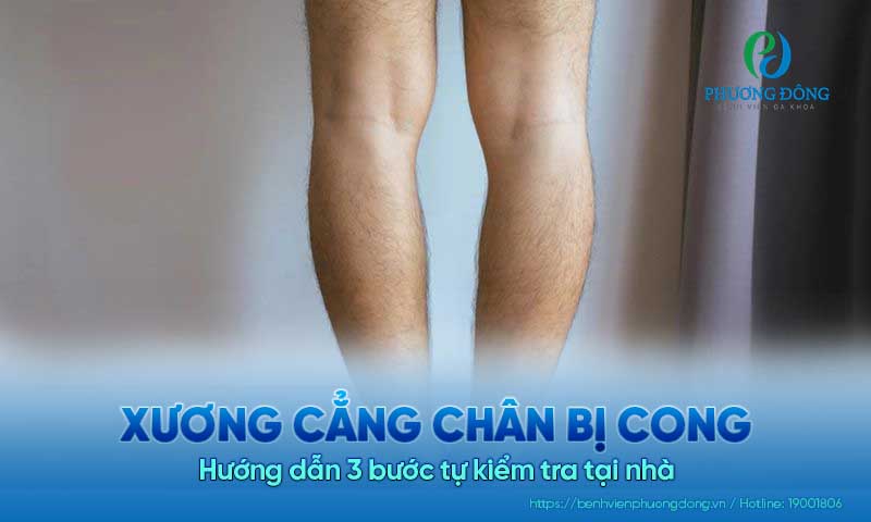 Hướng dẫn 3 bước tự kiểm tra xương cẳng chân bị cong tại nhà
