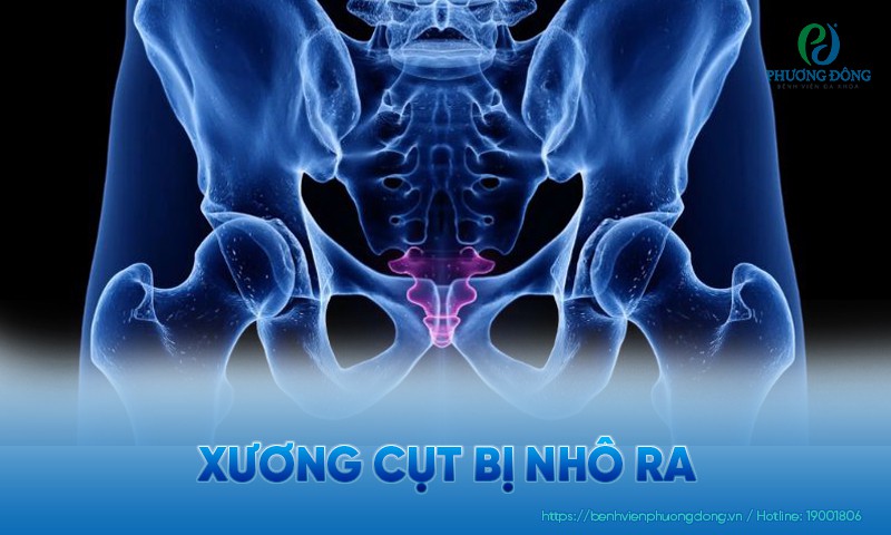 Xương cụt bị nhô ra: Triệu chứng, nguyên nhân và hướng điều trị