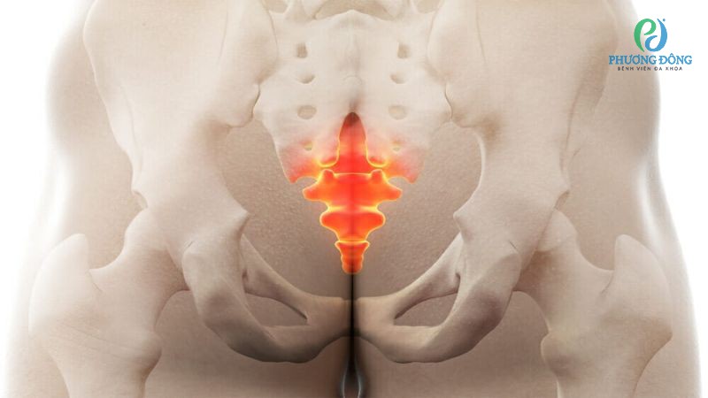 Dấu hiệu nhận biết lồi xương cụt