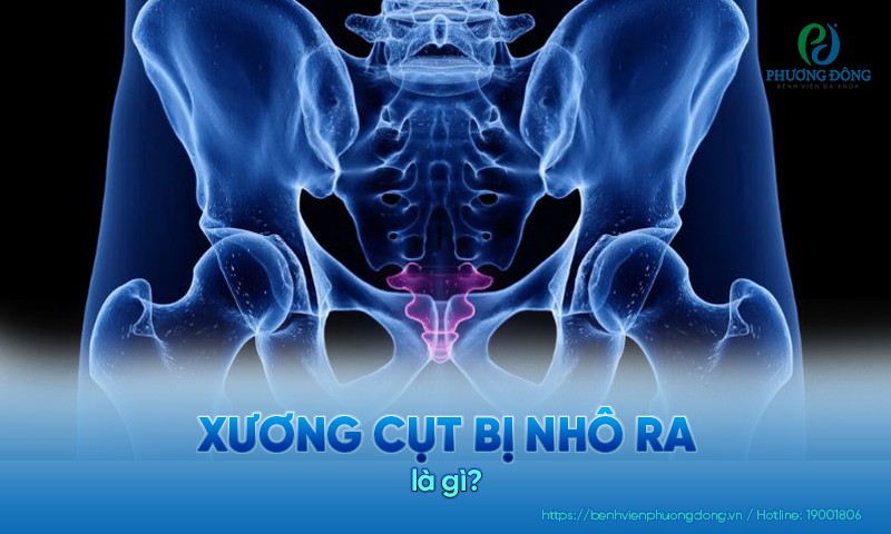 Xương cụt bị nhô ra là hiện tương xương cuối cùng cột sống lồi lên bất thường