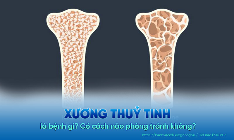 Xương thuỷ tinh là bệnh gì? Có cách nào phòng tránh không?