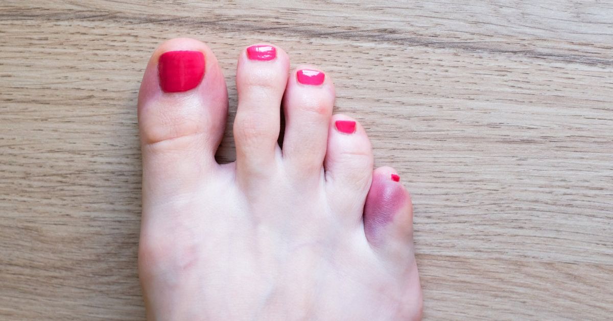 Ngón chân út bị gãy có nhiều hình thức khác nhau