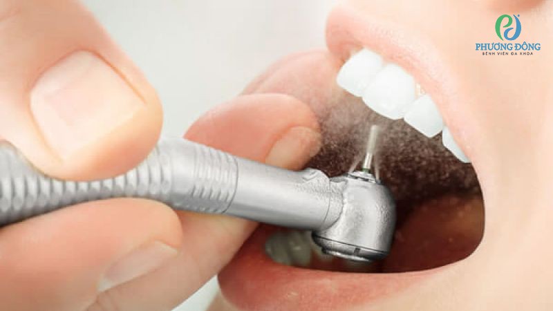 Mài xương ổ răng là thủ thuật y tế đơn giản, an toàn