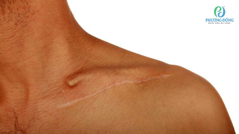 Bác sĩ giải đáp: Bị đau xương quai xanh bên phải do đâu?