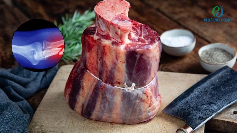 Gặp gỡ bác sĩ Cơ Xương Khớp: Bị gãy xương có nên ăn thịt bò không?