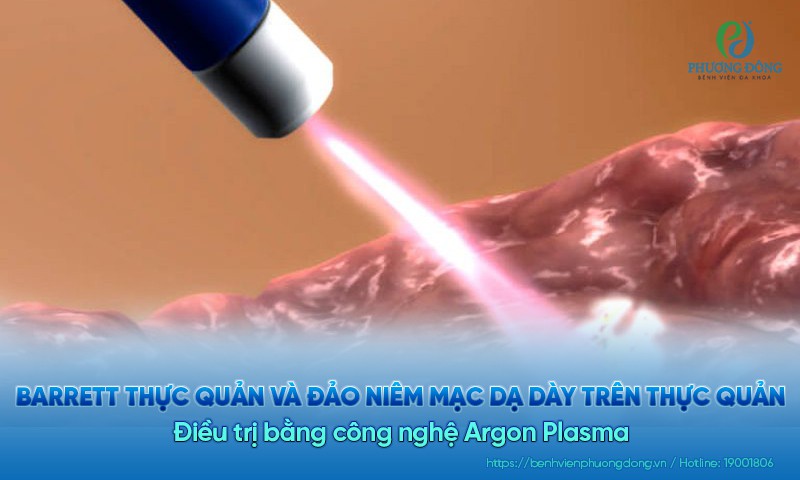 Điều trị barrett thực quản và đảo niêm mạc dạ dày trên thực quản bằng công nghệ Argon Plasma