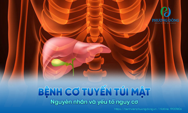 Bệnh cơ tuyến túi mật là gì? Nguyên nhân và yếu tố nguy cơ